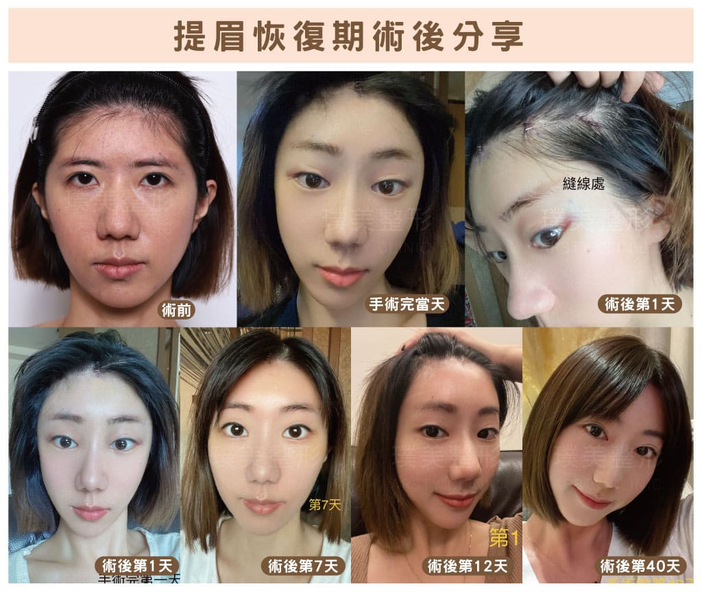Endoscopic Forehead Lift has a fast recovery period_E220704