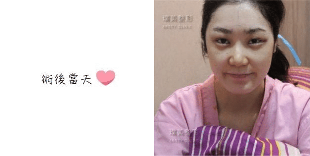 Endoscopic Forehead Lift改善眉壓眼術後當天