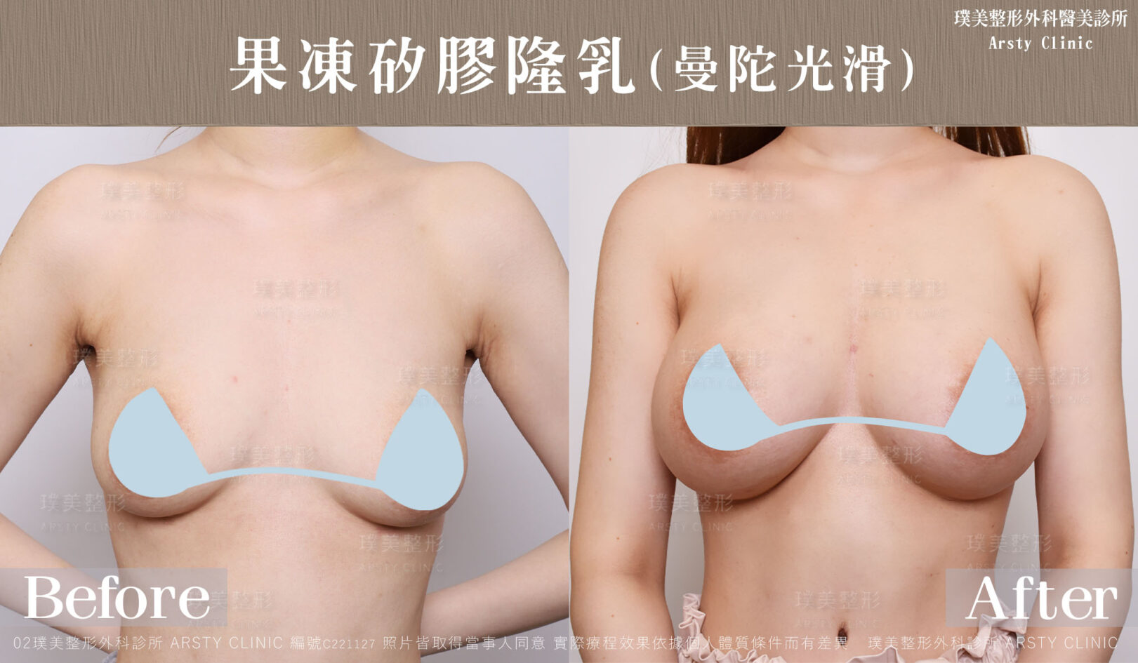 隆乳再進階！讓胸型更完美、觸感更自然，複合式隆乳優勢解析│璞美整形外科