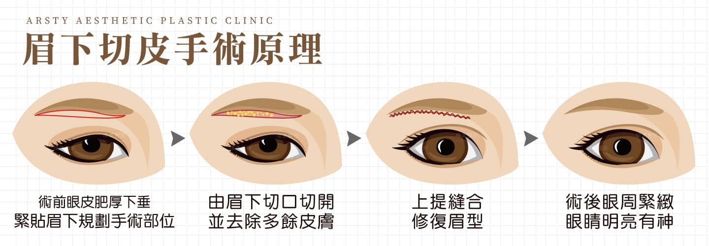 眉毛下切開手術の原則