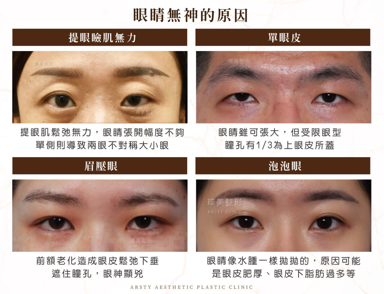 你累了嗎 了解眼睛無神的原因及改善方式 璞美整形外科