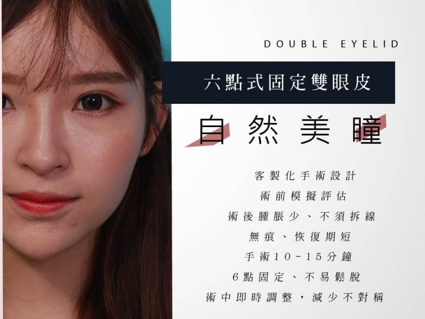 縫雙眼皮重修手術 87 荊偉政醫師、眼整形權威、眼整形推薦、眼整形外科、雙眼皮手術費用、雙眼皮手術推薦、縫雙眼皮、訂書針雙眼皮、雙眼皮PTT、ptt推薦、雙眼皮手術、雙眼皮價錢、雙眼皮失敗、雙眼皮風險、雙眼皮疤痕、台北、推薦