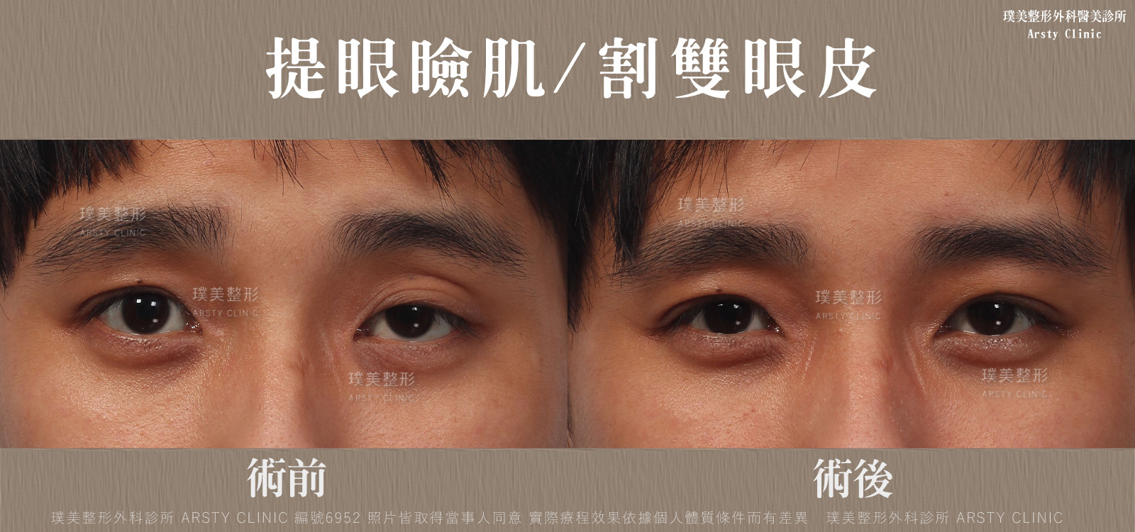 台北整形診所推薦_提眼肌_割雙眼皮-6952BA-局