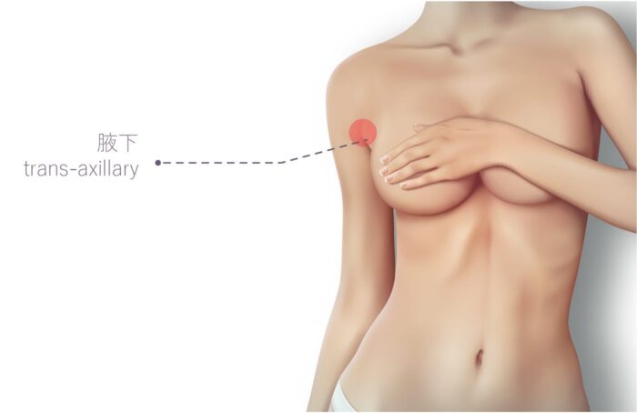 果凍隆乳切口-14 事業線 豐胸 胸部怎麼變大 隆乳 美胸