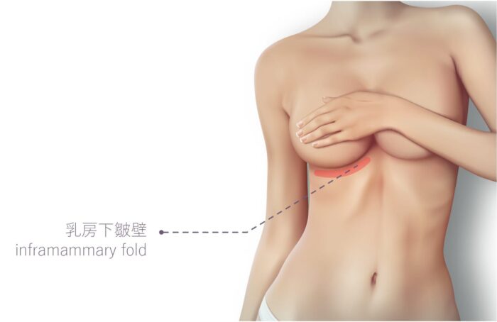 果凍隆乳切口-16 事業線 豐胸 胸部怎麼變大 隆乳 美胸