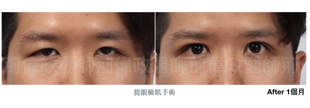 行銷用提眼瞼肌案例分享.003.jpeg 的副本 1