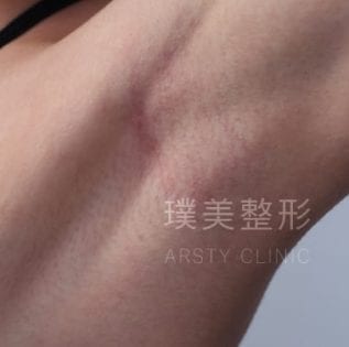 內視鏡果凍隆乳 8 0