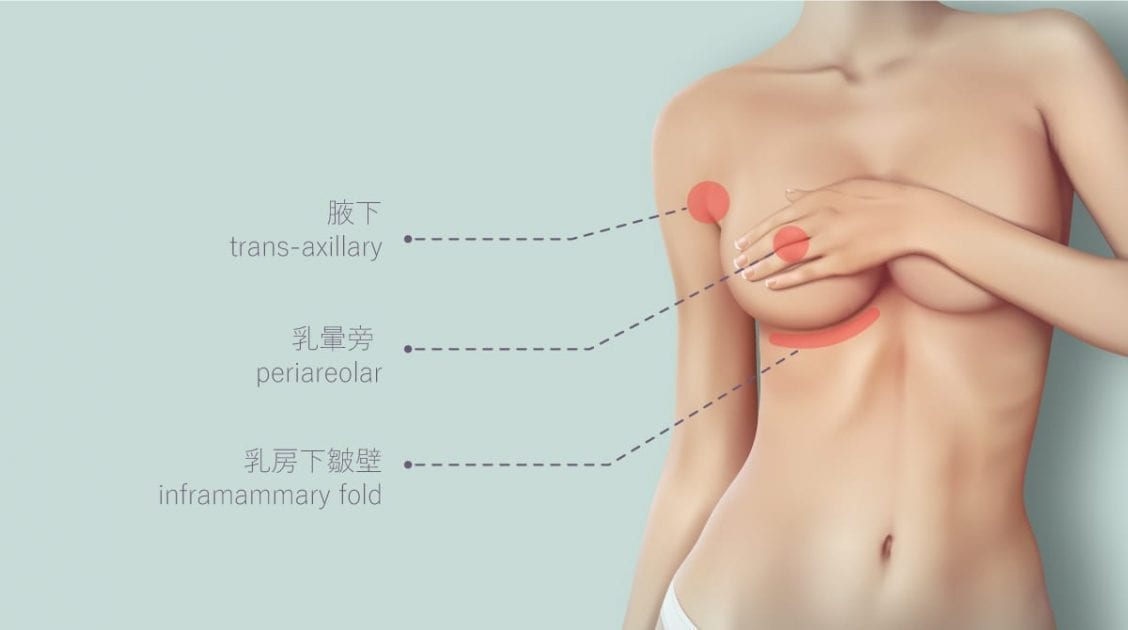 內視鏡果凍隆乳 8 果凍隆乳