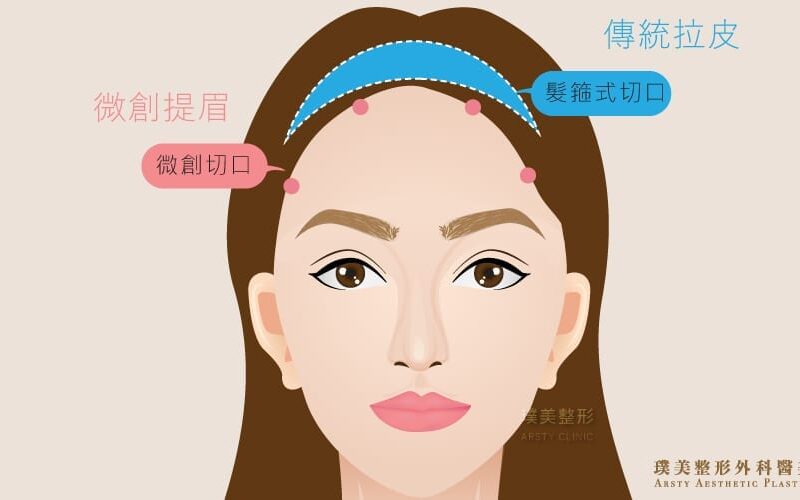 荊偉政醫師微創提眉推薦 埋線失敗、提眉ptt、提眉風險、提眉後遺症、創提、提眉費用、提眉手術恢復期-