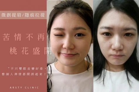 額頭整形彙整 璞美整形外科醫美診所