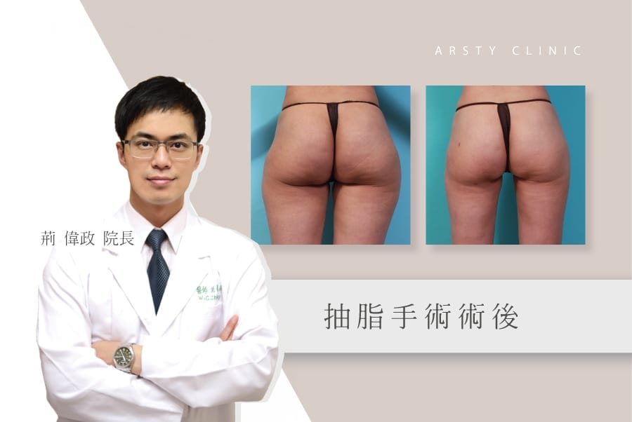 抽脂後遺症術後凹凸不平 醫師經驗與術後照顧能避免嗎 璞美整形外科