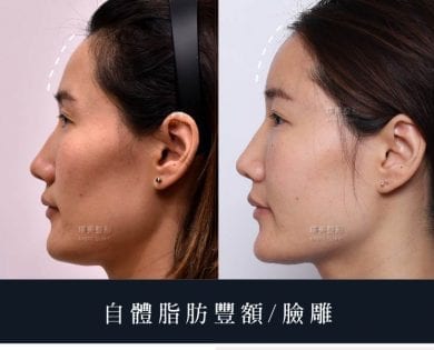 豐額失敗重修 墊鼻溝槽 天菜設計師逆齡心得 璞美整形外科