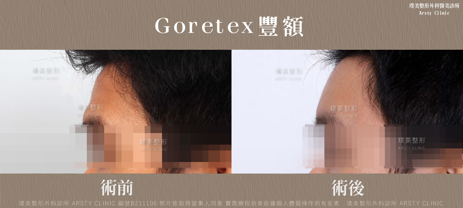 荊偉政醫師Goretex豐額、內視鏡豐額手術案例