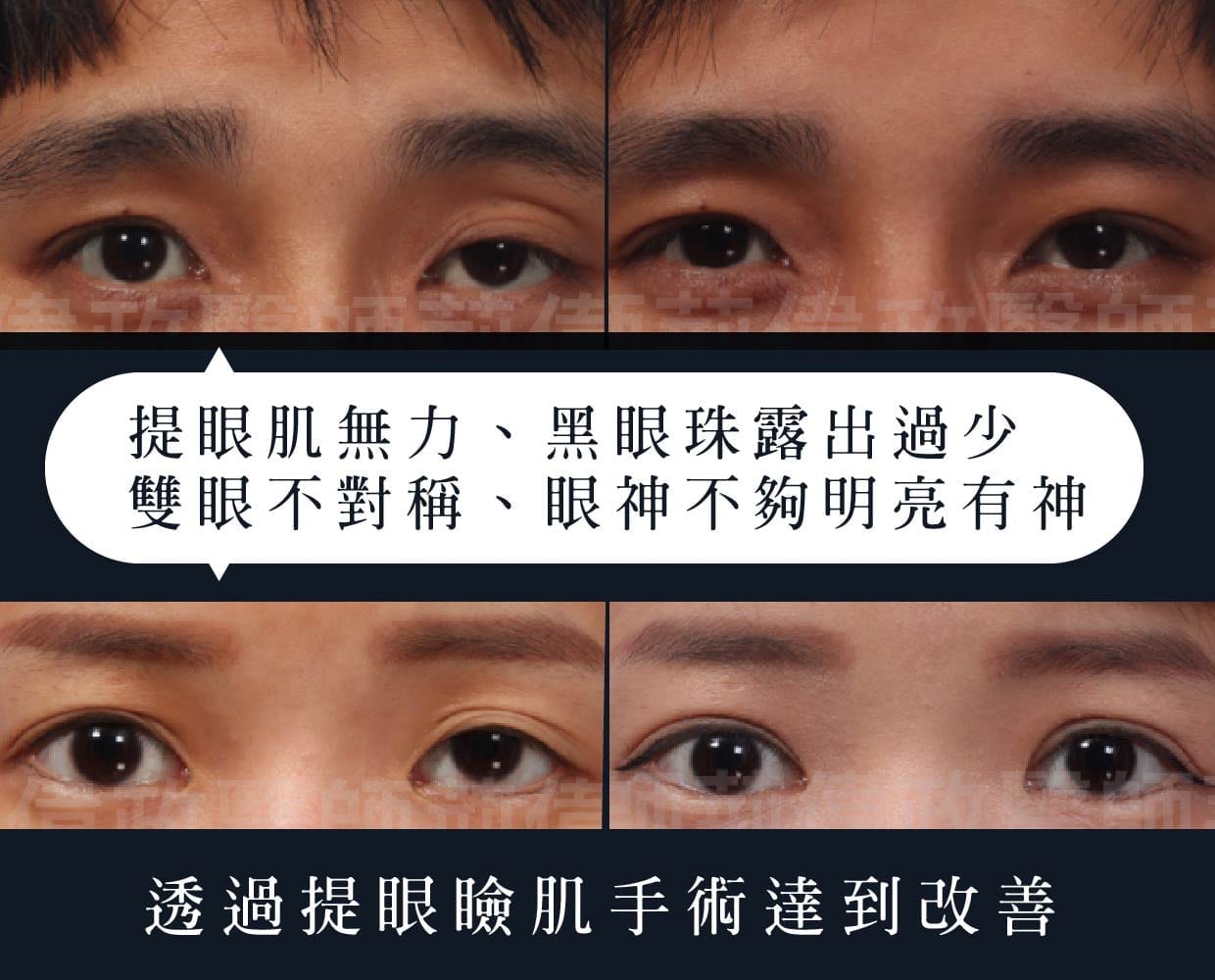 大小眼、提眼瞼肌、雙眼不對稱調整