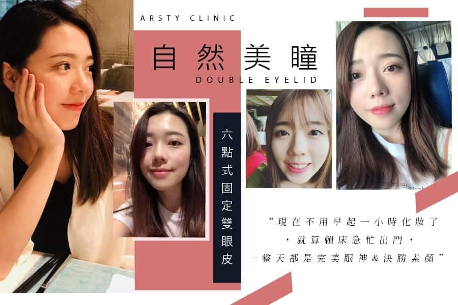 雙眼皮