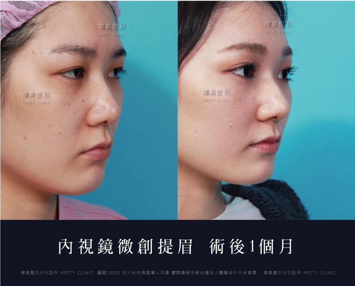 提眉失敗怎麼辦 微創提眉手術前的風險評估 璞美整形外科