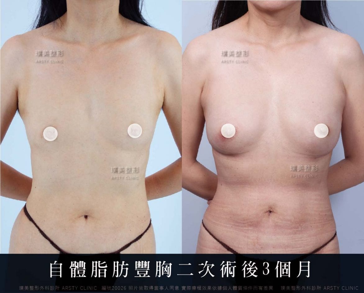 產後隆乳心得 自體脂肪 果凍矽膠隆乳幫你找回過去體態與自信 璞美整型
