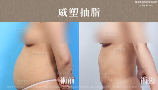 產後鬆弛肚皮緊實手術-肚皮回不去了?美麗媽咪抽脂拉提曲線再進化 30 抽脂會痛嗎、抽脂PTT、ptt推薦、抽脂療程、抽脂價錢、抽脂失敗、抽脂風險、抽脂疤痕、抽脂後遺症、台北、推薦、抽脂後遺症、大腿環抽、腹部環抽、荊偉政醫師、威塑推薦、余德毅醫師、二代威塑、推薦、快速瘦身