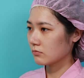 眉壓眼情形明顯