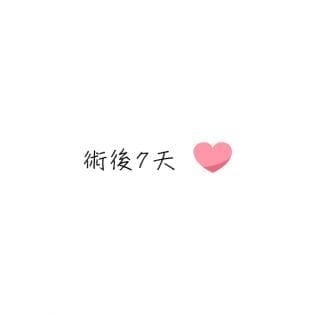 Endoscopic Forehead Lift術後一週案例