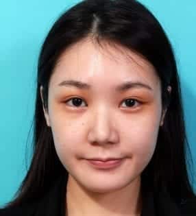 Endoscopic Forehead Lift術後一週案例