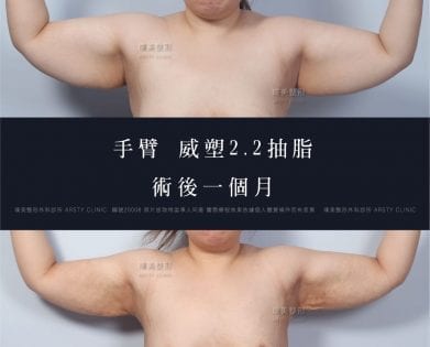 威塑2.2手臂抽脂 20 抽脂會痛嗎、抽脂PTT、ptt推薦、抽脂療程、抽脂價錢、抽脂失敗、抽脂風險、抽脂疤痕、抽脂後遺症、台北、推薦、抽脂後遺症、大腿環抽、腹部環抽、荊偉政醫師、威塑推薦、余德毅醫師、二代威塑、推薦、快速瘦身