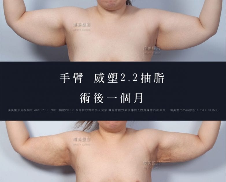 威塑2.2手臂抽脂/蝴蝶袖抽脂 19 抽脂會痛嗎、抽脂PTT、ptt推薦、抽脂療程、抽脂價錢、抽脂失敗、抽脂風險、抽脂疤痕、抽脂後遺症、台北、推薦、抽脂後遺症、大腿環抽、腹部環抽、荊偉政醫師、威塑推薦、余德毅醫師、二代威塑、推薦、快速瘦身