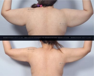 威塑2.2手臂抽脂 19 抽脂會痛嗎、抽脂PTT、ptt推薦、抽脂療程、抽脂價錢、抽脂失敗、抽脂風險、抽脂疤痕、抽脂後遺症、台北、推薦、抽脂後遺症、大腿環抽、腹部環抽、荊偉政醫師、威塑推薦、余德毅醫師、二代威塑、推薦、快速瘦身