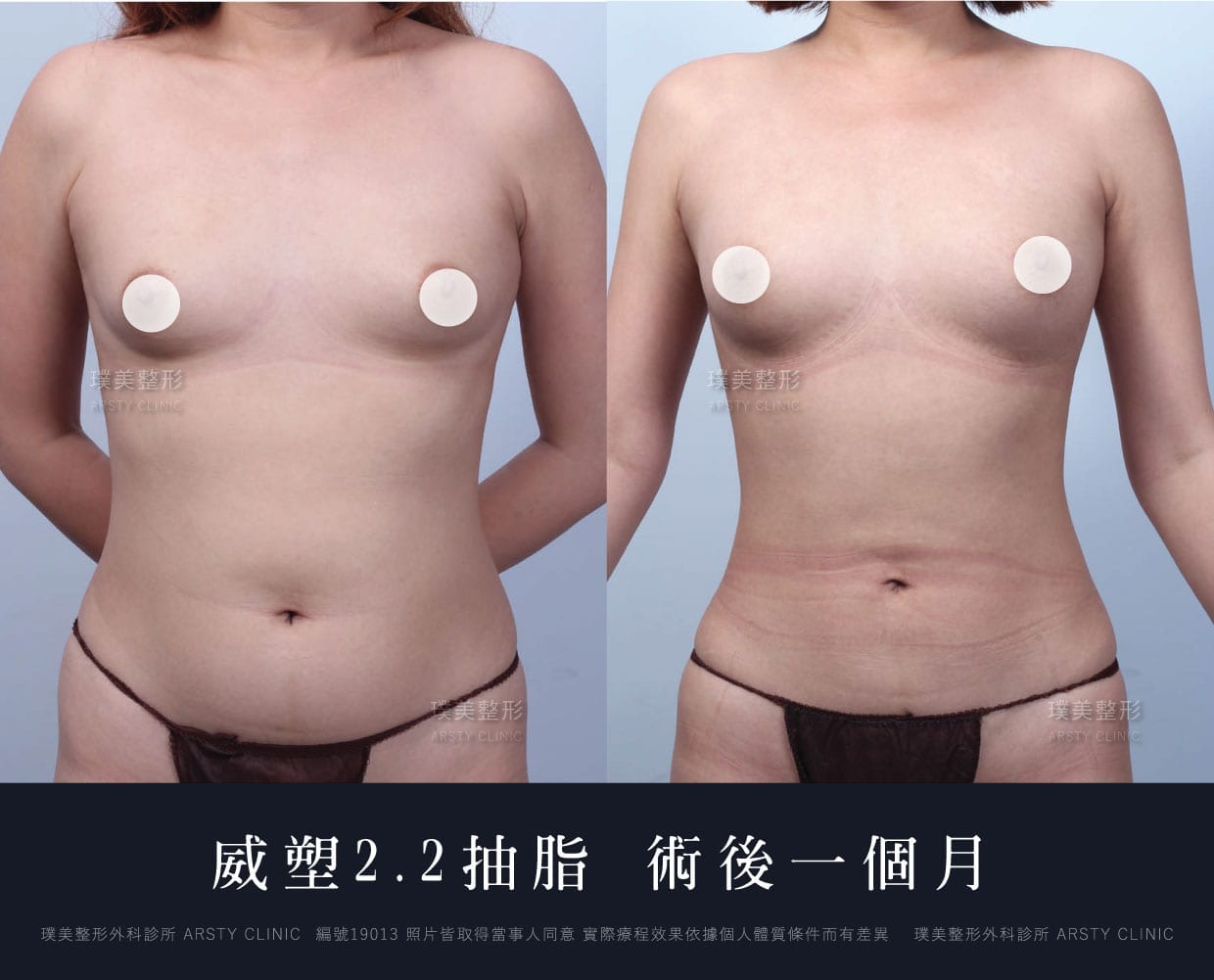 抽脂會痛嗎、抽脂PTT、ptt推薦、抽脂療程、抽脂價錢、抽脂失敗、抽脂風險、抽脂疤痕、抽脂後遺症、台北、推薦、抽脂後遺症、大腿環抽、腹部環抽、荊偉政醫師、威塑推薦、余德毅醫師、二代威塑、推薦、快速瘦身