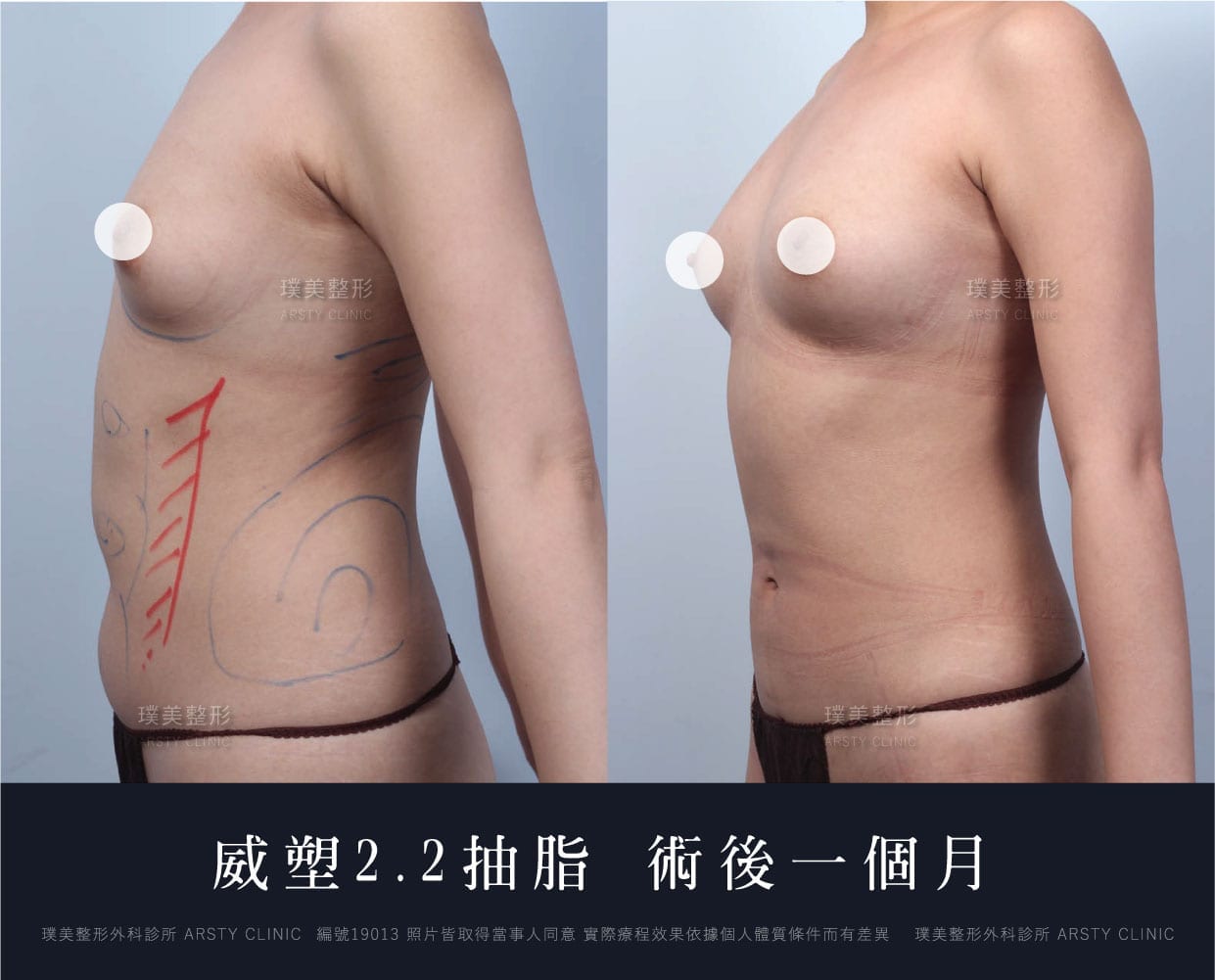 腹部環抽、肚肉、抽脂會痛嗎、抽脂PTT、ptt推薦、抽脂療程、抽脂價錢、抽脂失敗、抽脂風險、抽脂疤痕、抽脂後遺症、台北、推薦、抽脂後遺症、大腿環抽、腹部環抽、荊偉政醫師、威塑推薦、余德毅醫師、二代威塑、推薦、快速瘦身