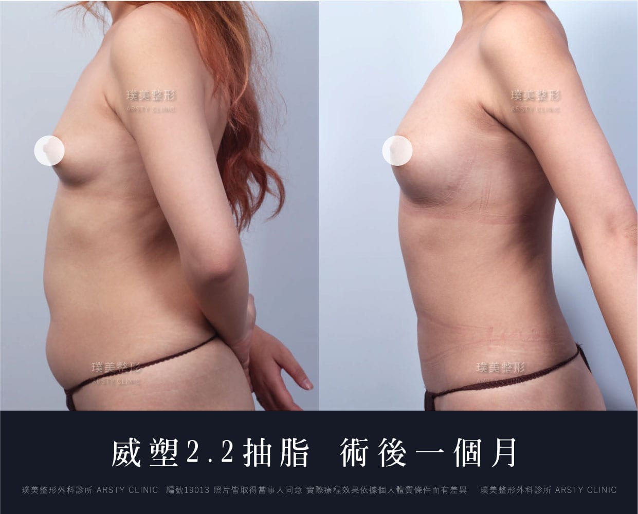 抽脂會痛嗎、抽脂PTT、ptt推薦、抽脂療程、抽脂價錢、抽脂失敗、抽脂風險、抽脂疤痕、抽脂後遺症、台北、推薦、抽脂後遺症、大腿環抽、腹部環抽、荊偉政醫師、威塑推薦、余德毅醫師、二代威塑、推薦、快速瘦身