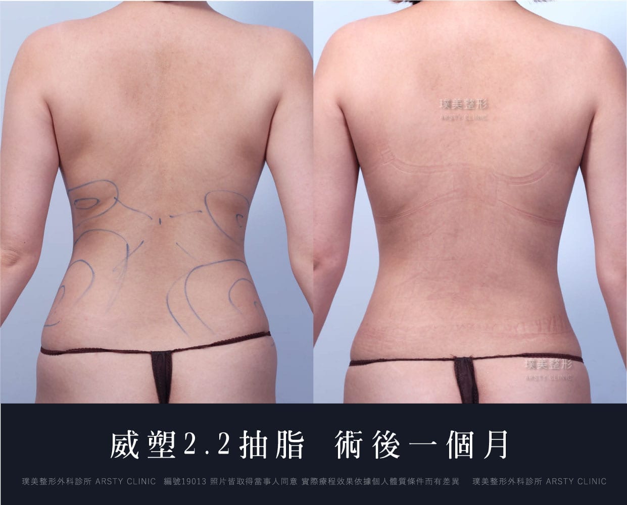 腹部環抽、肚肉、背肉、虎背、抽脂會痛嗎、抽脂PTT、ptt推薦、抽脂療程、抽脂價錢、抽脂失敗、抽脂風險、抽脂疤痕、抽脂後遺症、台北、推薦、抽脂後遺症、大腿環抽、腹部環抽、荊偉政醫師、威塑推薦、余德毅醫師、二代威塑、推薦、快速瘦身熊腰
