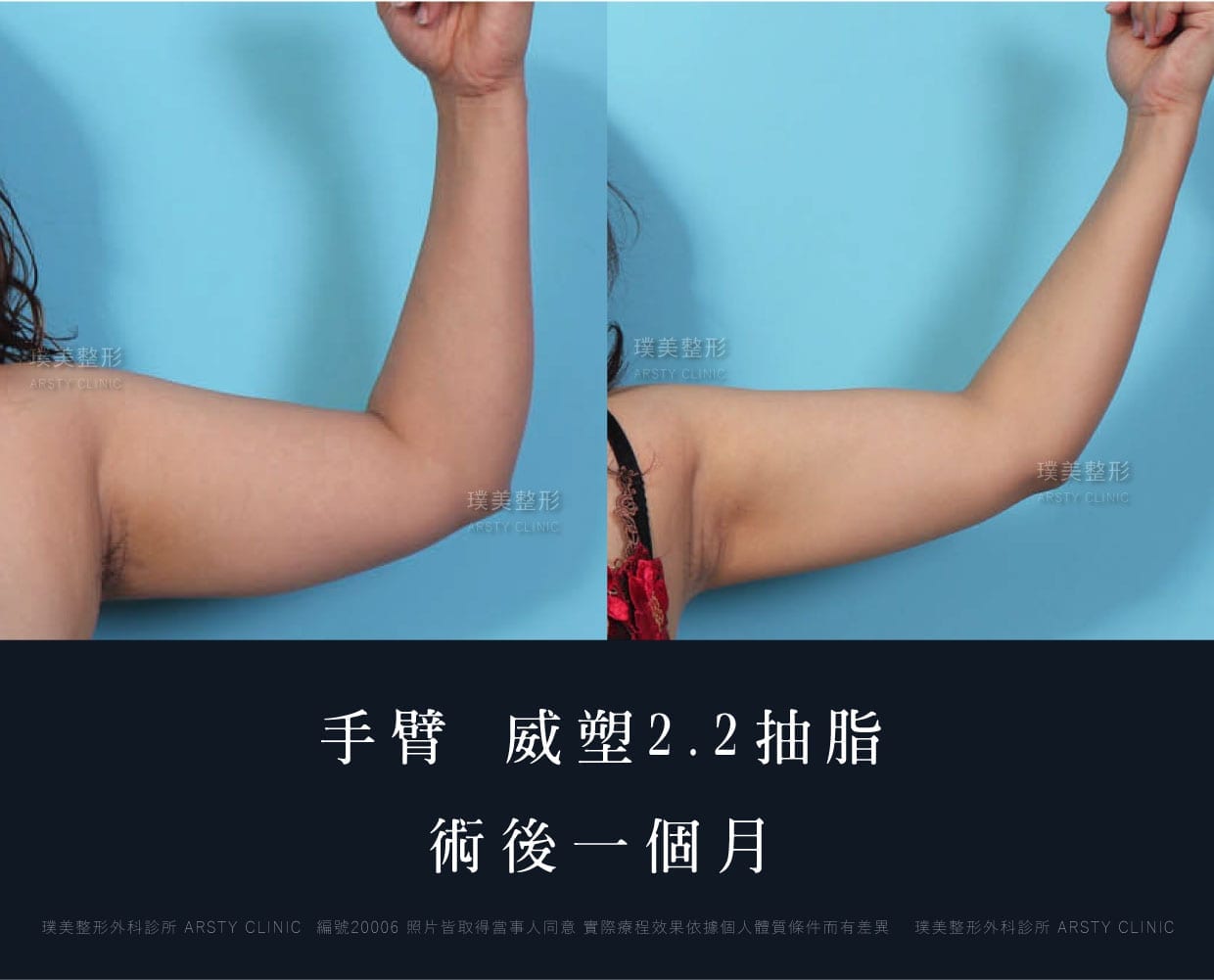 手臂、抽脂會痛嗎、抽脂PTT、ptt推薦、抽脂療程、抽脂價錢、抽脂失敗、抽脂風險、抽脂疤痕、抽脂後遺症、台北、推薦、抽脂後遺症、大腿環抽、腹部環抽、荊偉政醫師、威塑推薦、余德毅醫師、二代威塑、推薦、快速瘦身