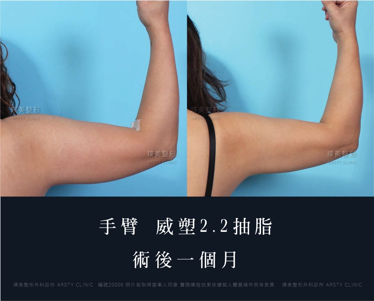 手臂、抽脂會痛嗎、抽脂PTT、ptt推薦、抽脂療程、抽脂價錢、抽脂失敗、抽脂風險、抽脂疤痕、抽脂後遺症、台北、推薦、抽脂後遺症、大腿環抽、腹部環抽、荊偉政醫師、威塑推薦、余德毅醫師、二代威塑、推薦、快速瘦身