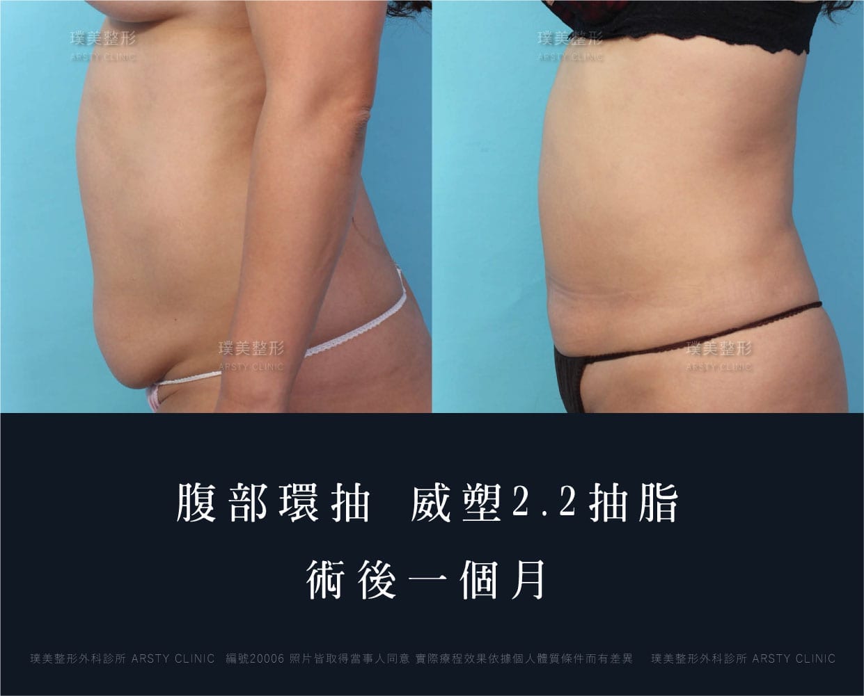 腹部環抽、肚肉、抽脂會痛嗎、抽脂PTT、ptt推薦、抽脂療程、抽脂價錢、抽脂失敗、抽脂風險、抽脂疤痕、抽脂後遺症、台北、推薦、抽脂後遺症、大腿環抽、腹部環抽、荊偉政醫師、威塑推薦、余德毅醫師、二代威塑、推薦、快速瘦身