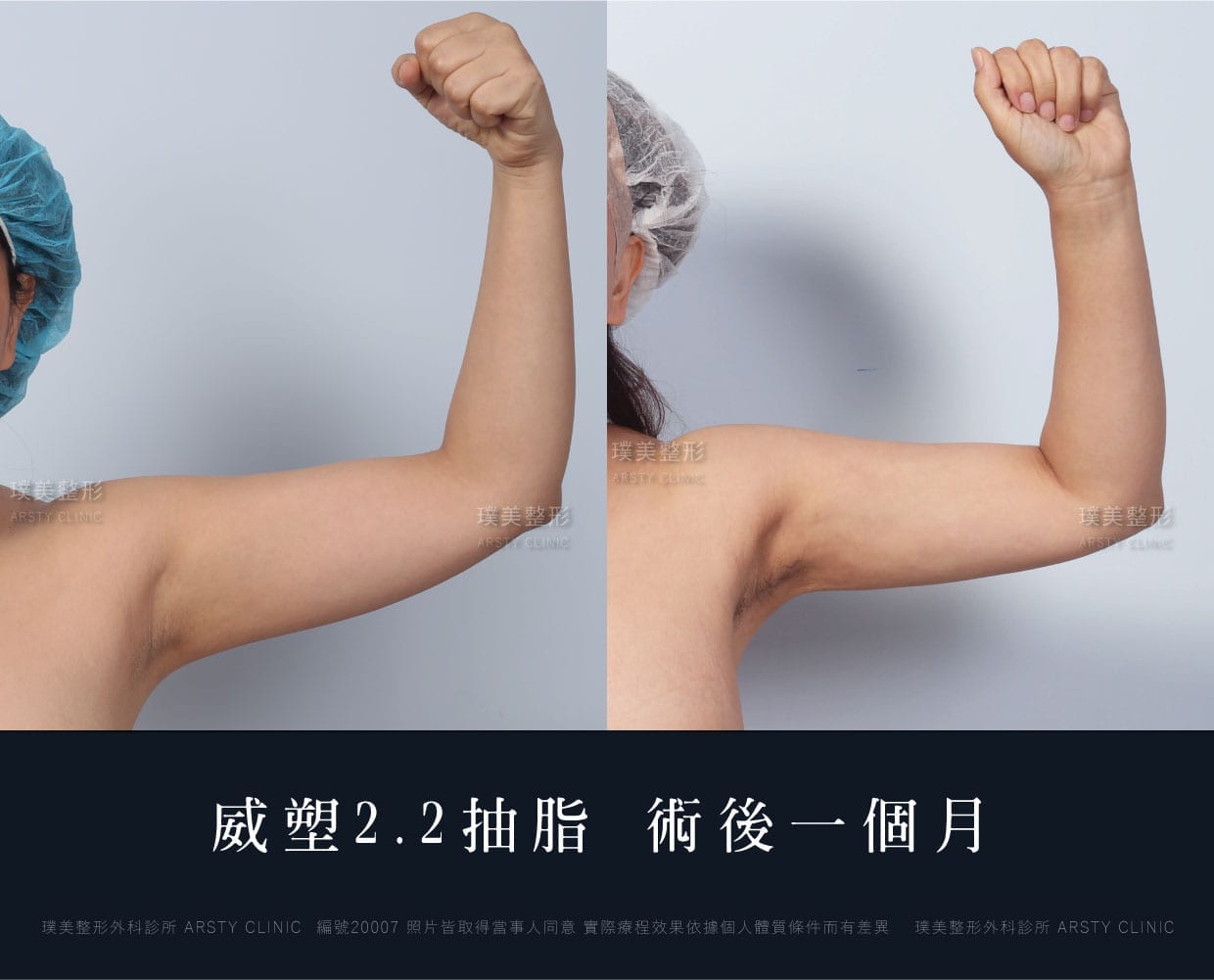 抽脂會痛嗎、抽脂PTT、ptt推薦、抽脂療程、抽脂價錢、抽脂失敗、抽脂風險、抽脂疤痕、抽脂後遺症、台北、推薦、抽脂後遺症、大腿環抽、腹部環抽、荊偉政醫師、威塑推薦、余德毅醫師、二代威塑、推薦、快速瘦身