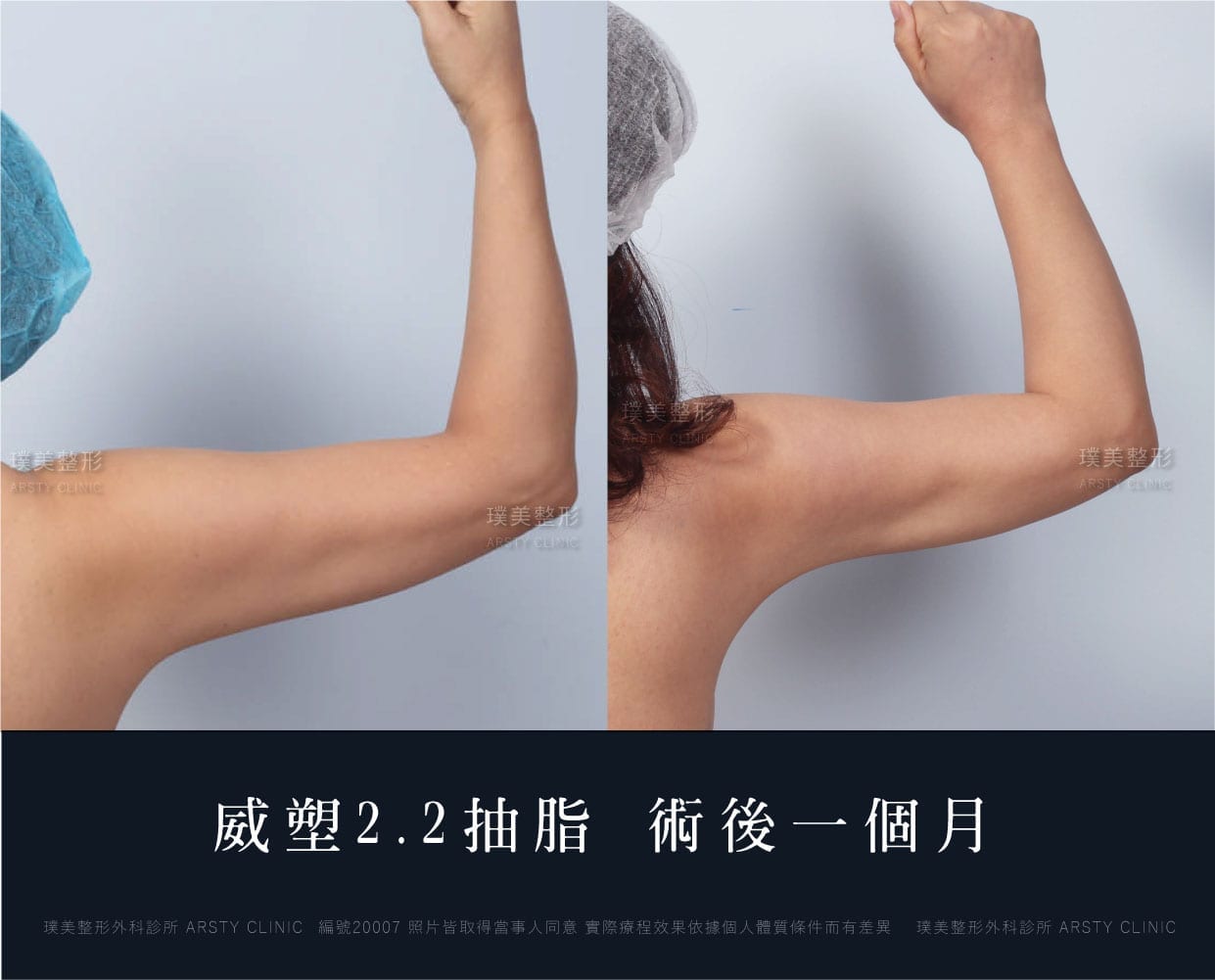 手臂、手臂抽脂、抽脂會痛嗎、抽脂PTT、ptt推薦、抽脂療程、抽脂價錢、抽脂失敗、抽脂風險、抽脂疤痕、抽脂後遺症、台北、推薦、抽脂後遺症、大腿環抽、腹部環抽、荊偉政醫師、威塑推薦、余德毅醫師、二代威塑、推薦、快速瘦身
