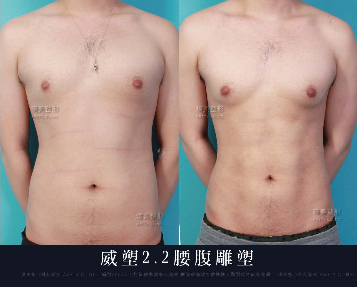 腹部環抽、肚肉、背肉、抽脂PTT、ptt推薦、抽脂療程、抽脂價錢、抽脂失敗、抽脂風險、抽脂疤痕、抽脂後遺症、台北、推薦、抽脂後遺症、大腿環抽、腹部環抽、荊偉政醫師、威塑推薦、余德毅醫師、二代威塑