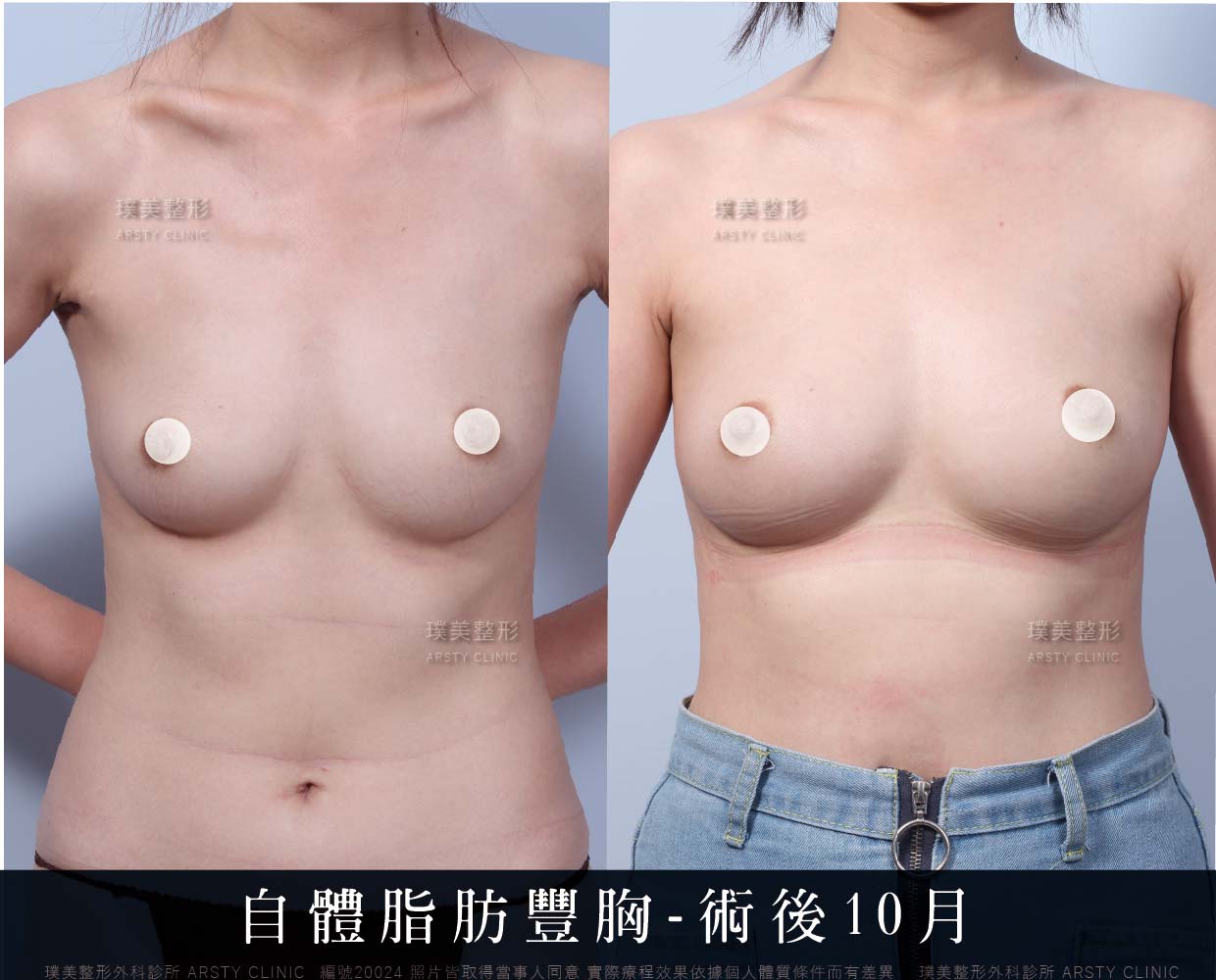 自體脂肪隆乳、隆乳、抽脂會痛嗎、抽脂PTT、ptt推薦、抽脂療程、抽脂價錢、抽脂失敗、抽脂風險、抽脂疤痕、抽脂後遺症、台北、推薦、抽脂後遺症、大腿環抽、腹部環抽、荊偉政醫師、威塑推薦、余德毅醫師、二代威塑、推薦、快速瘦身
