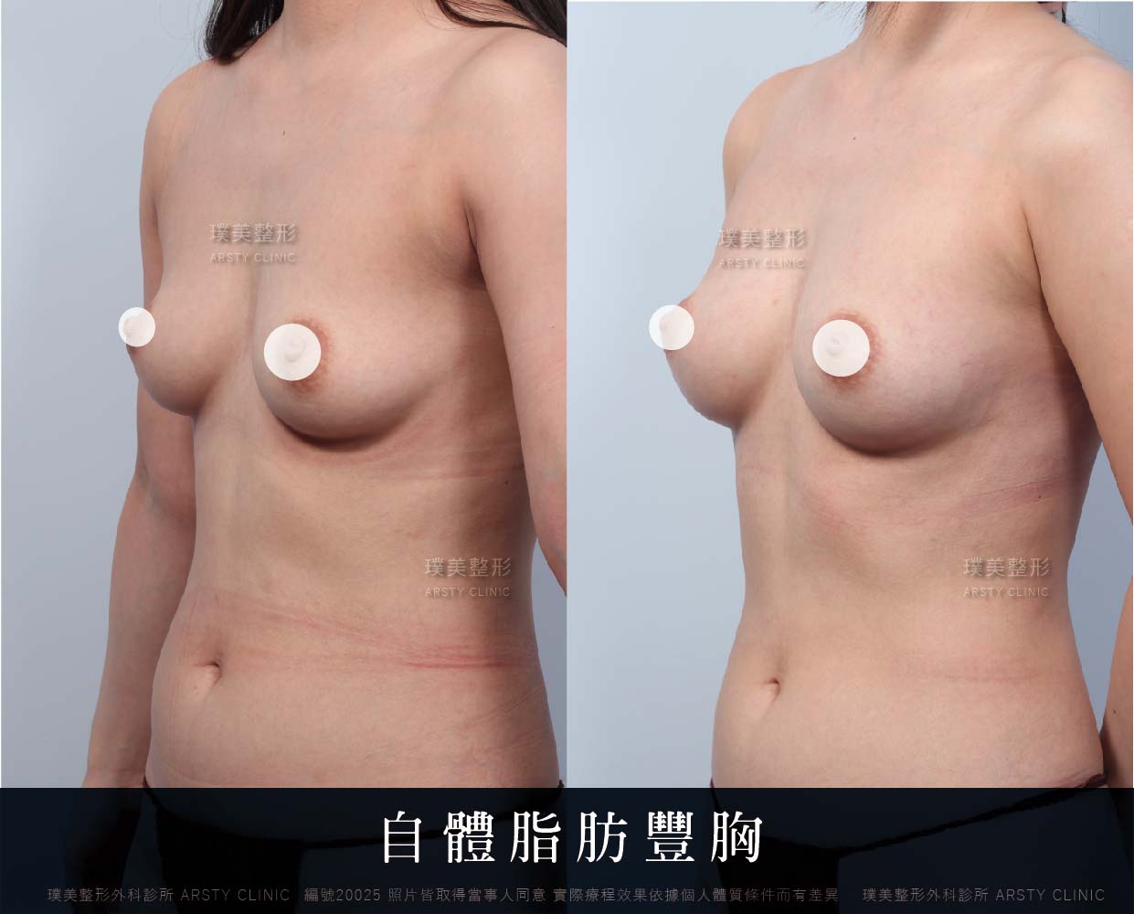 自體脂肪隆乳、隆乳、抽脂會痛嗎、抽脂PTT、ptt推薦、抽脂療程、抽脂價錢、抽脂失敗、抽脂風險、抽脂疤痕、抽脂後遺症、台北、推薦、抽脂後遺症、大腿環抽、腹部環抽、荊偉政醫師、威塑推薦、余德毅醫師、二代威塑、推薦、快速瘦身