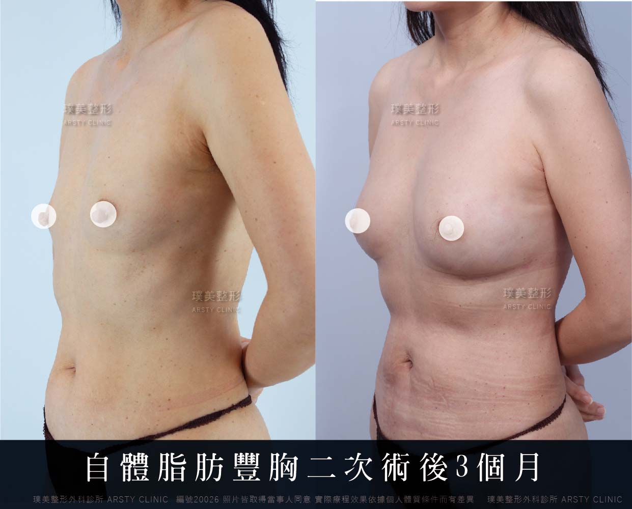 抽脂會痛嗎、抽脂PTT、ptt推薦、抽脂療程、抽脂價錢、抽脂失敗、抽脂風險、抽脂疤痕、抽脂後遺症、台北、推薦、抽脂後遺症、大腿環抽、腹部環抽、荊偉政醫師、威塑推薦、余德毅醫師、二代威塑、推薦、快速瘦身