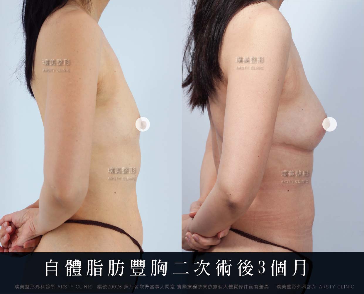 自體脂肪隆乳、隆乳、抽脂會痛嗎、抽脂PTT、ptt推薦、抽脂療程、抽脂價錢、抽脂失敗、抽脂風險、抽脂疤痕、抽脂後遺症、台北、推薦、抽脂後遺症、大腿環抽、腹部環抽、荊偉政醫師、威塑推薦、余德毅醫師、二代威塑、推薦、快速瘦身