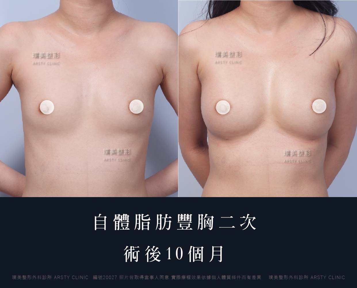 自體脂肪隆乳、隆乳、抽脂會痛嗎、抽脂PTT、ptt推薦、抽脂療程、抽脂價錢、抽脂失敗、抽脂風險、抽脂疤痕、抽脂後遺症、台北、推薦、抽脂後遺症、大腿環抽、腹部環抽、荊偉政醫師、威塑推薦、余德毅醫師、二代威塑、推薦、快速瘦身