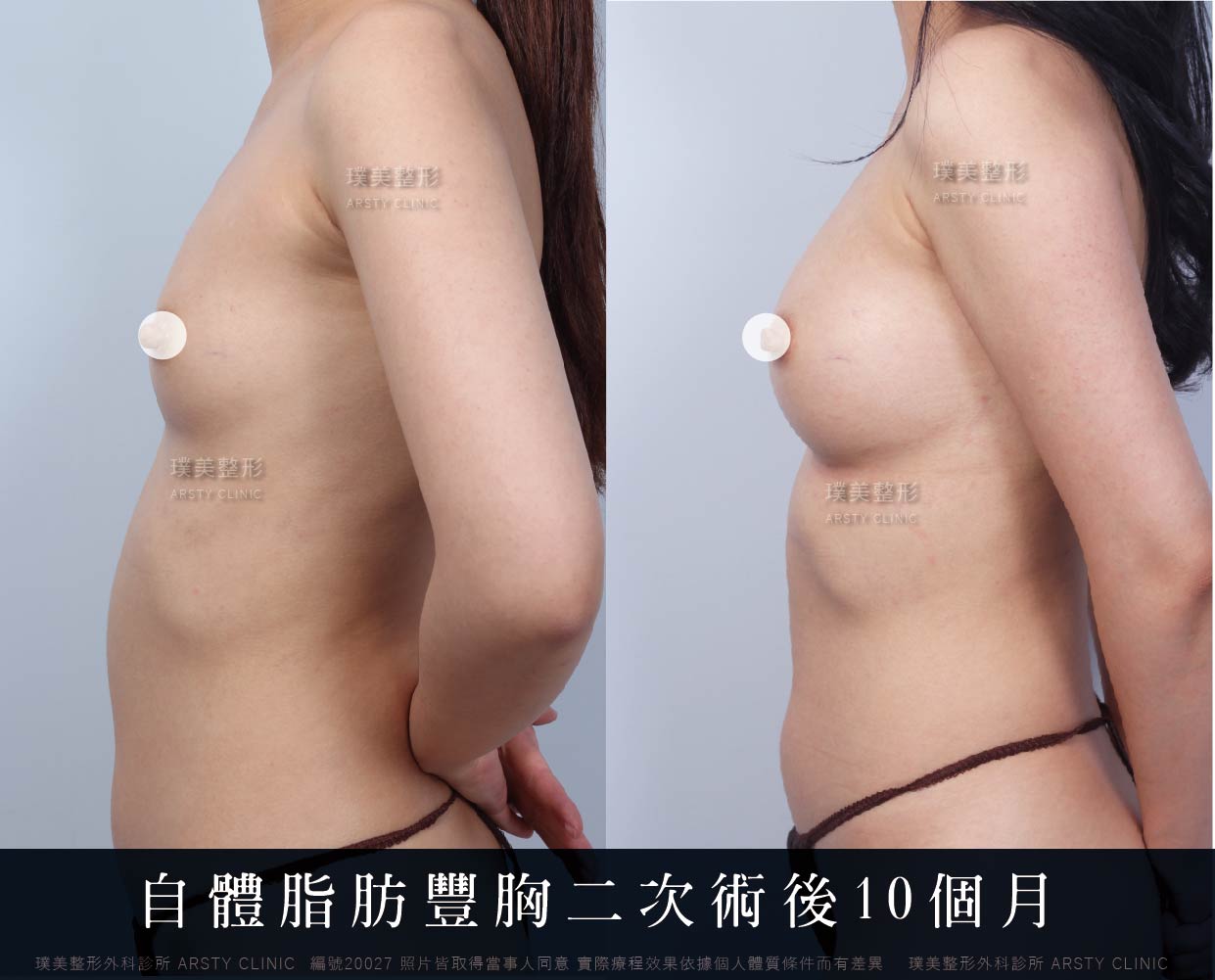 自體脂肪隆乳、隆乳、抽脂會痛嗎、抽脂PTT、ptt推薦、抽脂療程、抽脂價錢、抽脂失敗、抽脂風險、抽脂疤痕、抽脂後遺症、台北、推薦、抽脂後遺症、大腿環抽、腹部環抽、荊偉政醫師、威塑推薦、余德毅醫師、二代威塑、推薦、快速瘦身