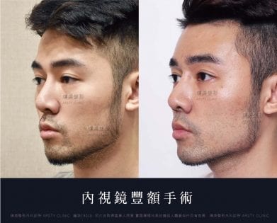 豐額失敗重修 墊鼻溝槽 天菜設計師逆齡心得 璞美整形外科