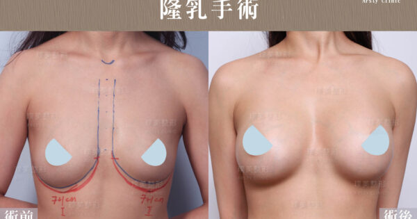 璞美專業隆乳醫師果凍矽膠隆乳術前後對照圖