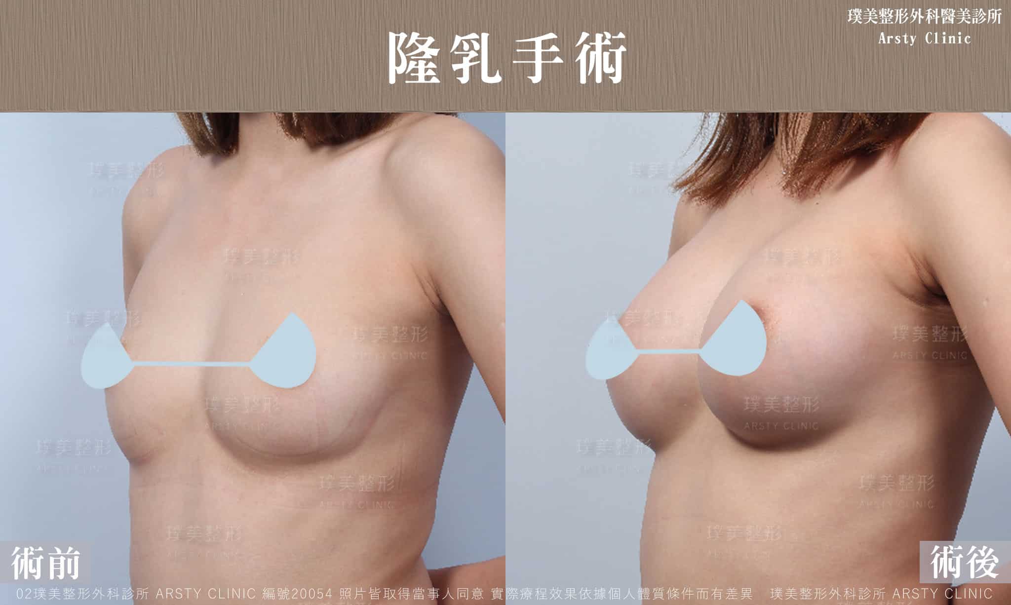 果凍隆乳案例照-06-20054左45