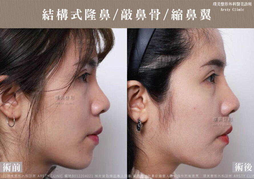 璞美隆鼻縮鼻翼敲鼻骨案例術後右側的鼻型變化