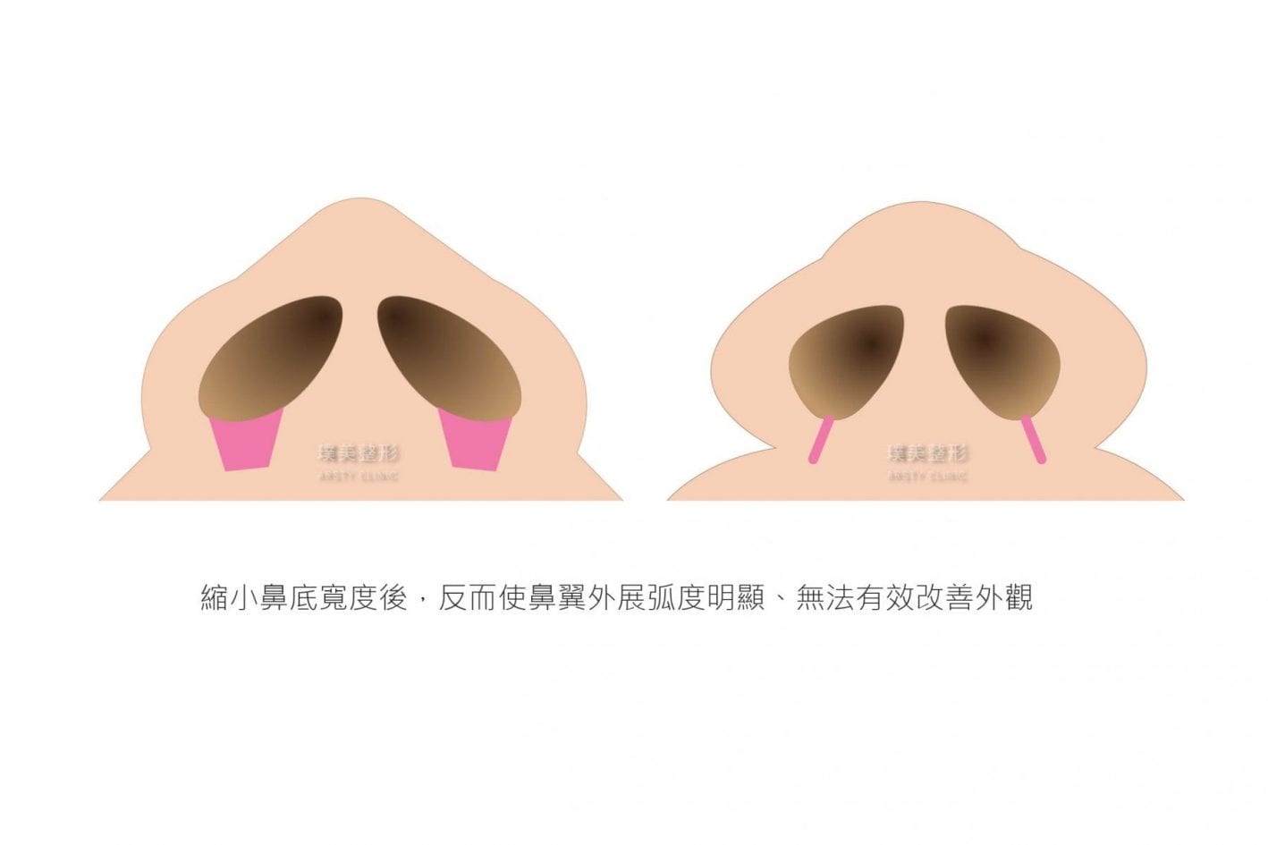 縮鼻翼價格縮鼻翼推薦縮鼻翼日記縮鼻翼後遺症縮鼻翼權威縮鼻翼手術余德毅醫師荊偉政醫師璞美醫美縮鼻翼療程縮鼻翼恢復期縮鼻翼消腫縮鼻翼多久後恢復自然縮鼻翼價錢縮鼻翼失敗縮鼻翼風險縮鼻翼疤痕縮鼻翼後遺症縮鼻翼鼻ptt推薦縮鼻翼台北縮鼻翼dcard推薦