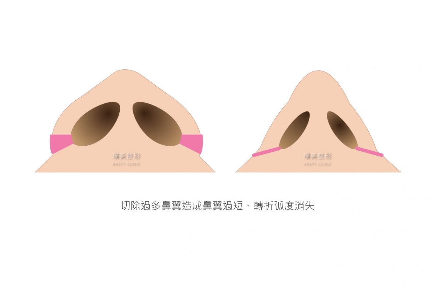 縮鼻翼價格縮鼻翼推薦縮鼻翼日記縮鼻翼後遺症縮鼻翼權威縮鼻翼手術余德毅醫師荊偉政醫師璞美醫美縮鼻翼療程縮鼻翼恢復期縮鼻翼消腫縮鼻翼多久後恢復自然縮鼻翼價錢縮鼻翼失敗縮鼻翼風險縮鼻翼疤痕縮鼻翼後遺症縮鼻翼鼻ptt推薦縮鼻翼台北縮鼻翼dcard推薦